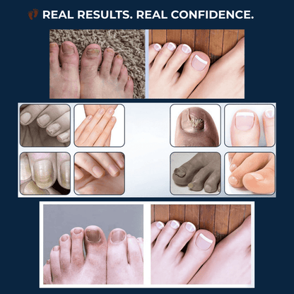 Cura Nail